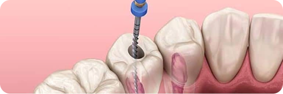 endodontics-dentistry-main-image.png