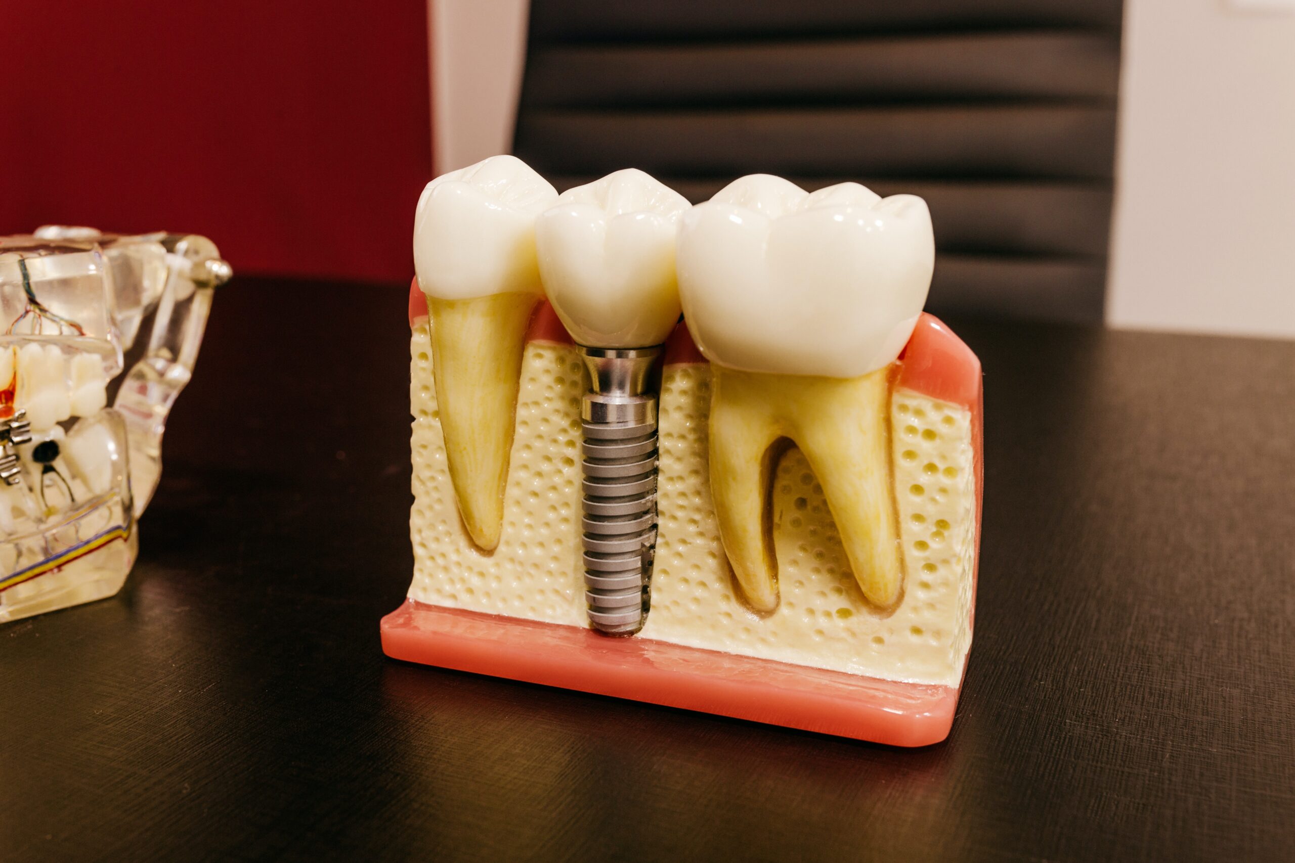 Dental-Implant.jpg