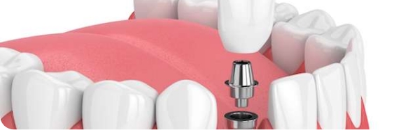 Dental-Implants.jpg