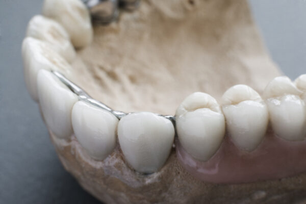 dental implants up close