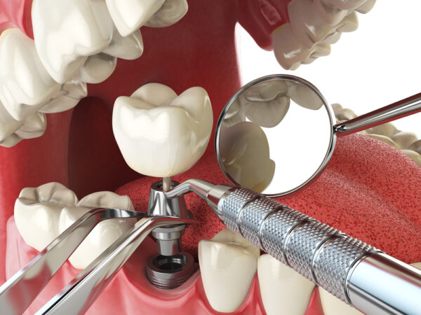dentists use a high level of expertise to place dental implants explains the cost