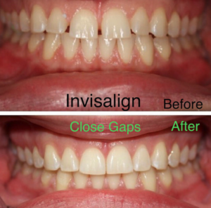 before-invisalign-2.png