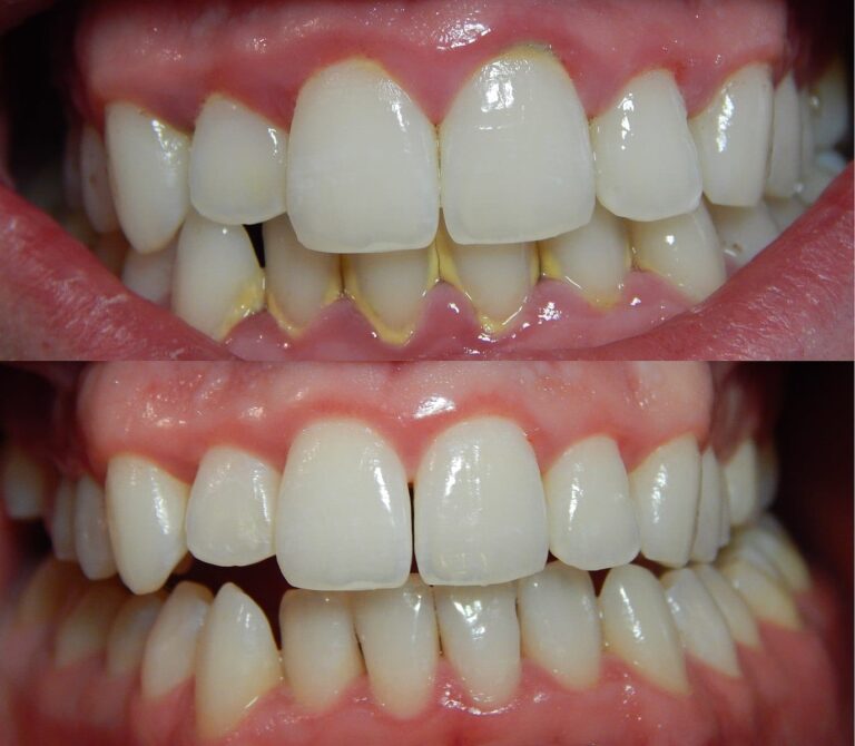 there are two pictures of a smile with missing teeth