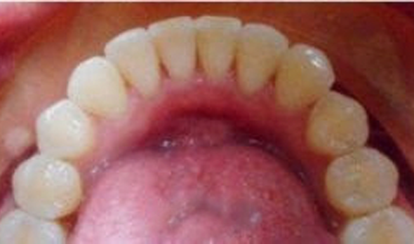 a close up of a person with a tooth with a missing tooth