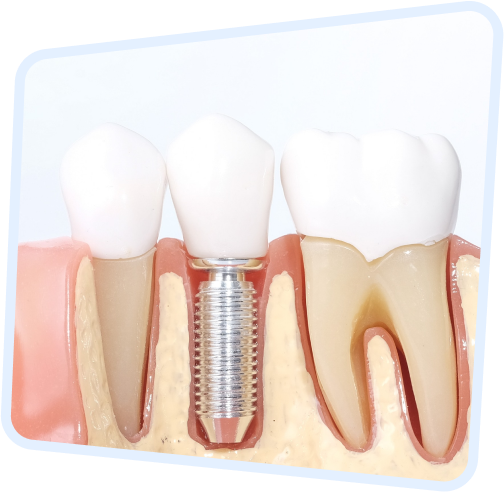 a close up of a tooth with a dental implant on it