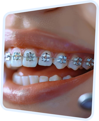 a close up of a woman ' s mouth with braces and teeth