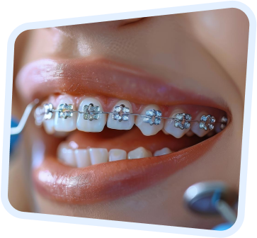 a close up of a woman ' s mouth with braces and teeth