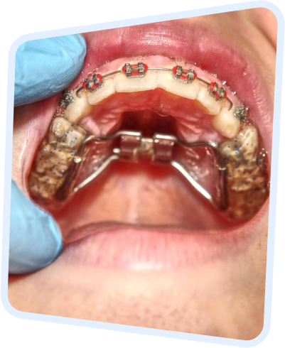 a close up of a person holding a tooth with braces on