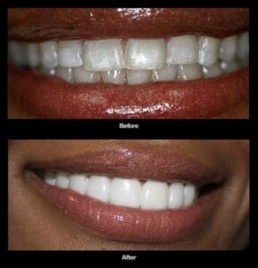 a close up of a person ' s teeth before and after a dental procedure