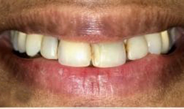 a close up of a person ' s teeth before and after dental treatment