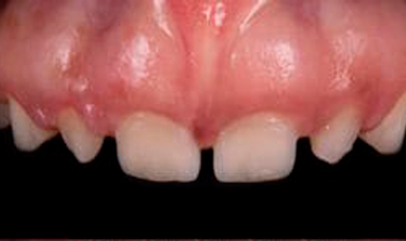 a close up of a person ' s mouth with a tooth missing