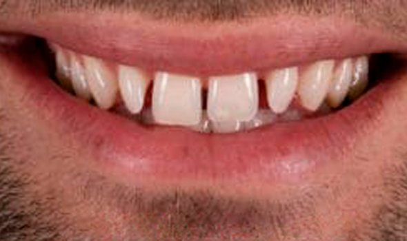 a close up of a man ' s teeth with a missing tooth