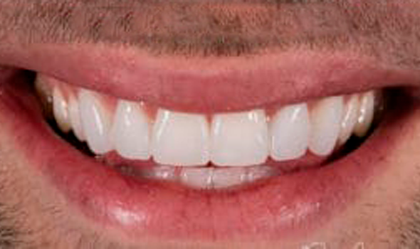 a close up of a man ' s smile with a toothbrush in his mouth