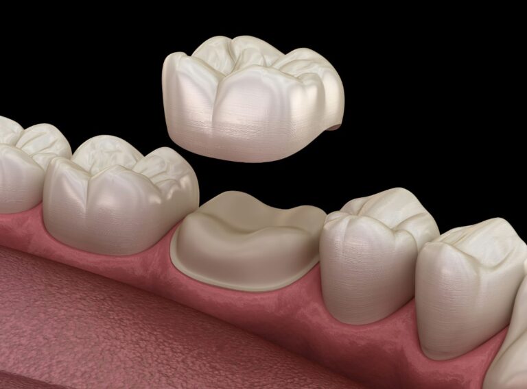 a close up of a tooth with a missing tooth and a missing tooth