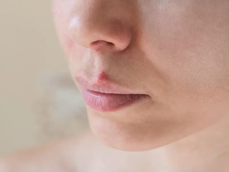 Cold Sores 101: What They Are and How Laser Therapy Can Help 