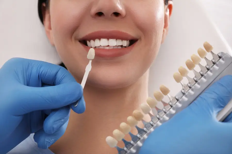 The Latest Innovations in Veneer Procedures: What to Expect