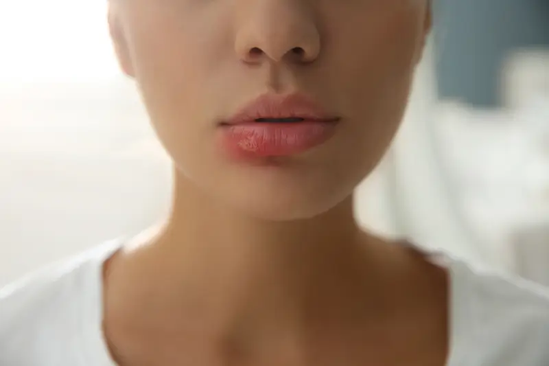 Cold Sores 101: What They Are and How Laser Therapy Can Help 