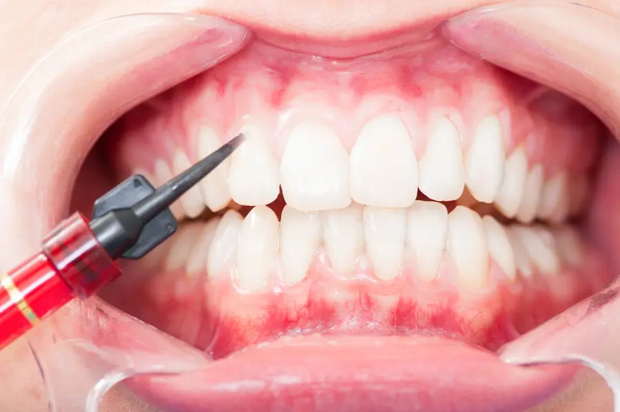 What to Expect After Laser Periodontal Therapy: Post-Treatment Care and Tips for Recovery