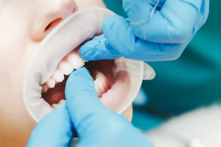 The Latest Innovations in Veneer Procedures: What to Expect