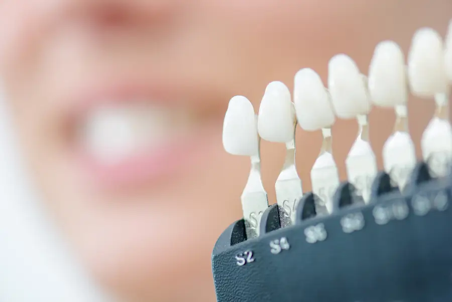 The Latest Innovations in Veneer Procedures: What to Expect