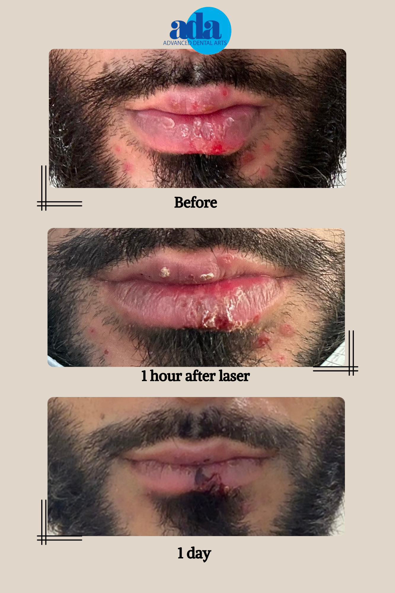 cold sore laser treatment NYC