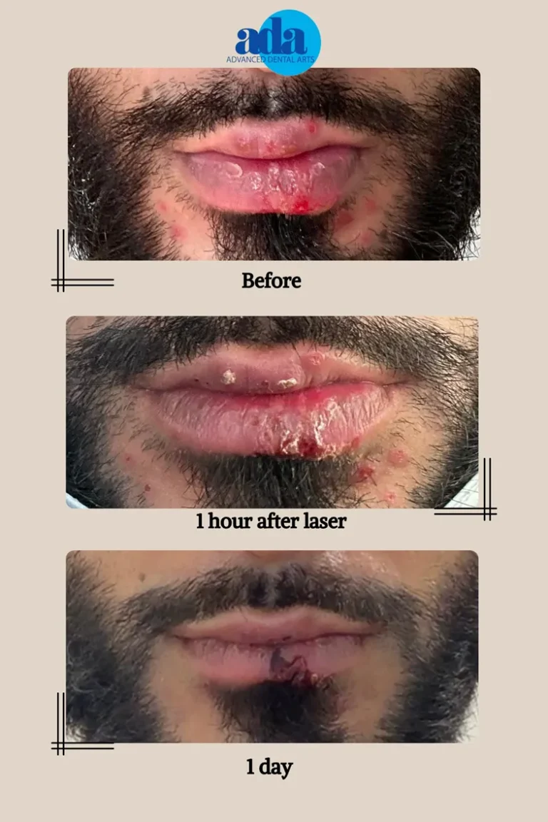 cold sore laser treatment NYC